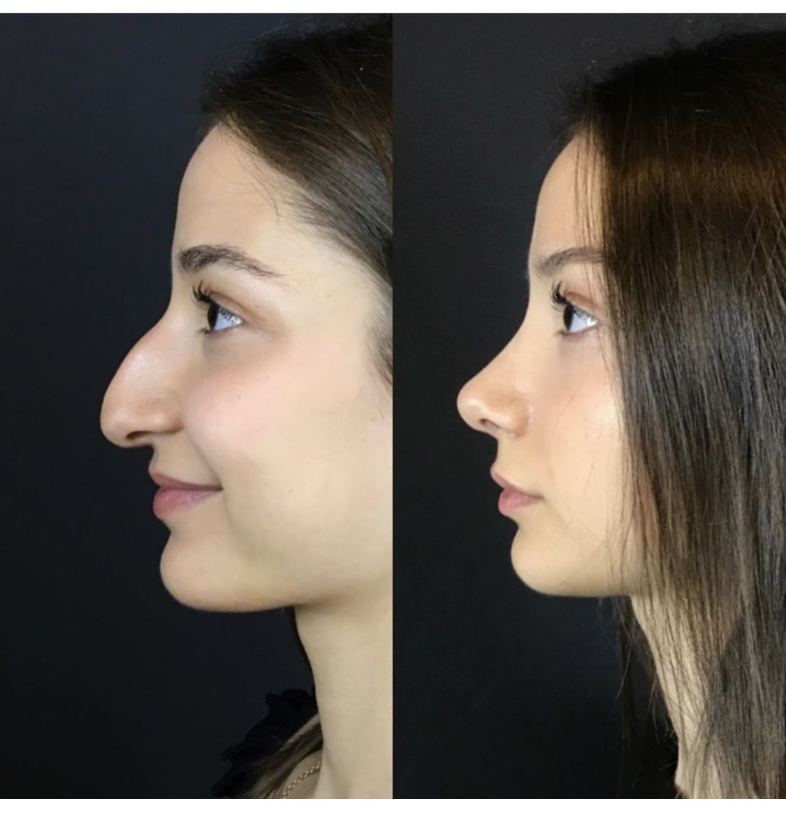 коррекция носа до и после фото