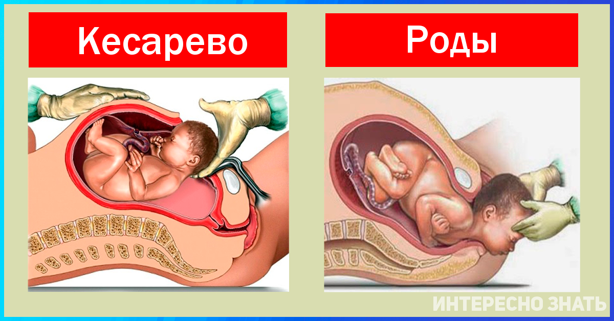 Кесарево сечение рисунок