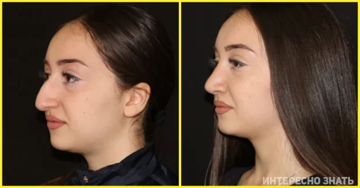 Фото ринопластики до и после нос. Гюсан ринопластика. Бульбообразный нос ринопластика. Осман Давудов ринопластика. Ринопластика Эленшлегер.
