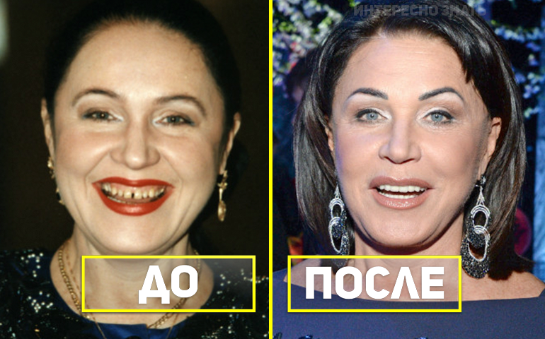 Фото Гагариной До И После Пластики